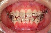 開咬（かいこう）治療中